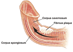 Peyronie's Disease