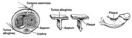 Peyronie's Disease treatment